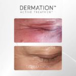Dermation - regeneracja skóry
